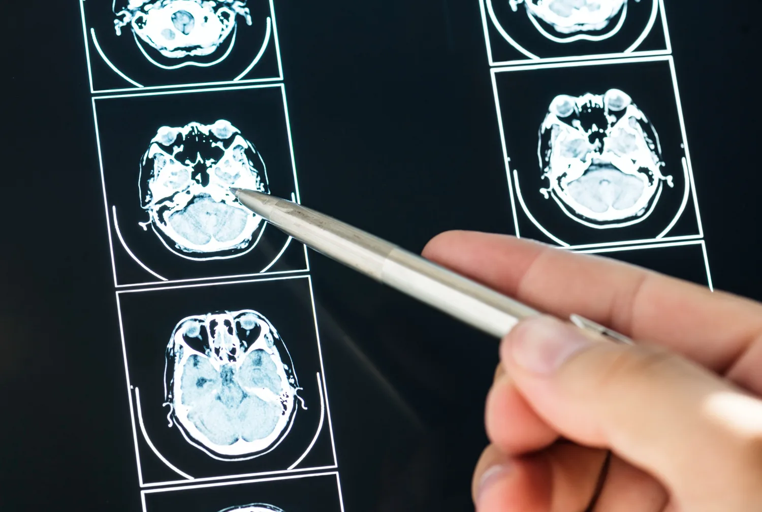 Hematoma subdural en CDMX: Diagnóstico y tratamiento neuroquirúrgico avanzado