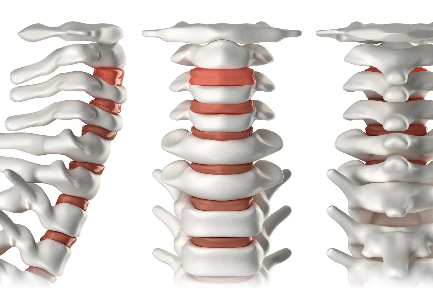 Tratamiento Avanzado para Hernia de disco lumbar en CDMX: Cirugía Neurológica Moderna